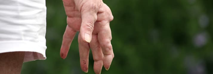 Help for Arthritis Sufferers in the Mount Maunganui Area
