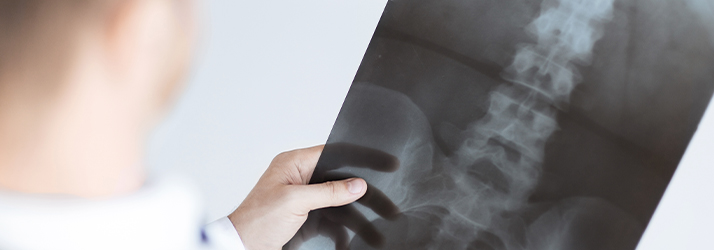 The Benefits Of Structural Chiropractic Care With Initial X-Rays — Especially For Rheumatoid Arthritis In Mount Maunganui Tauranga NZ